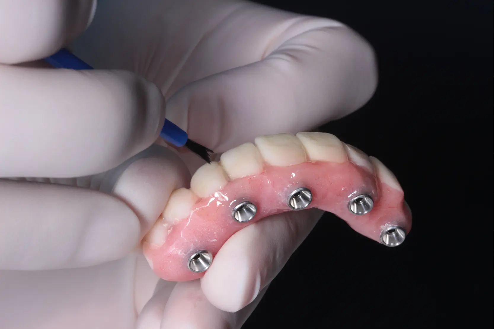 ZEdu Article: The implant-prosthetic misfit: analogue and digital impression and other factors involved